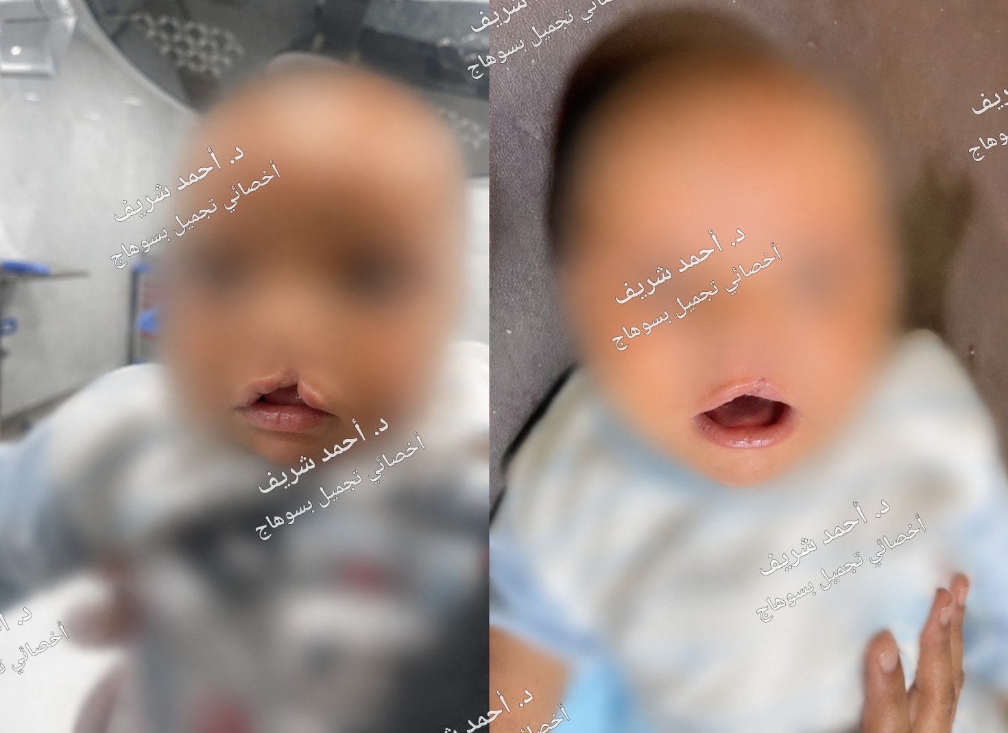 الشفة الأرنبية