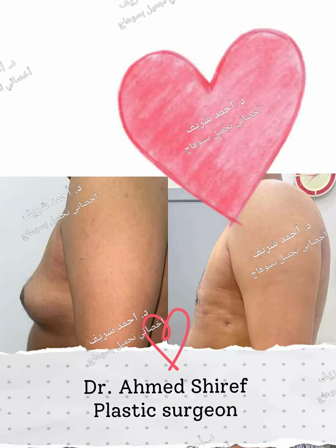 تثدي الرجال — صورة 3
