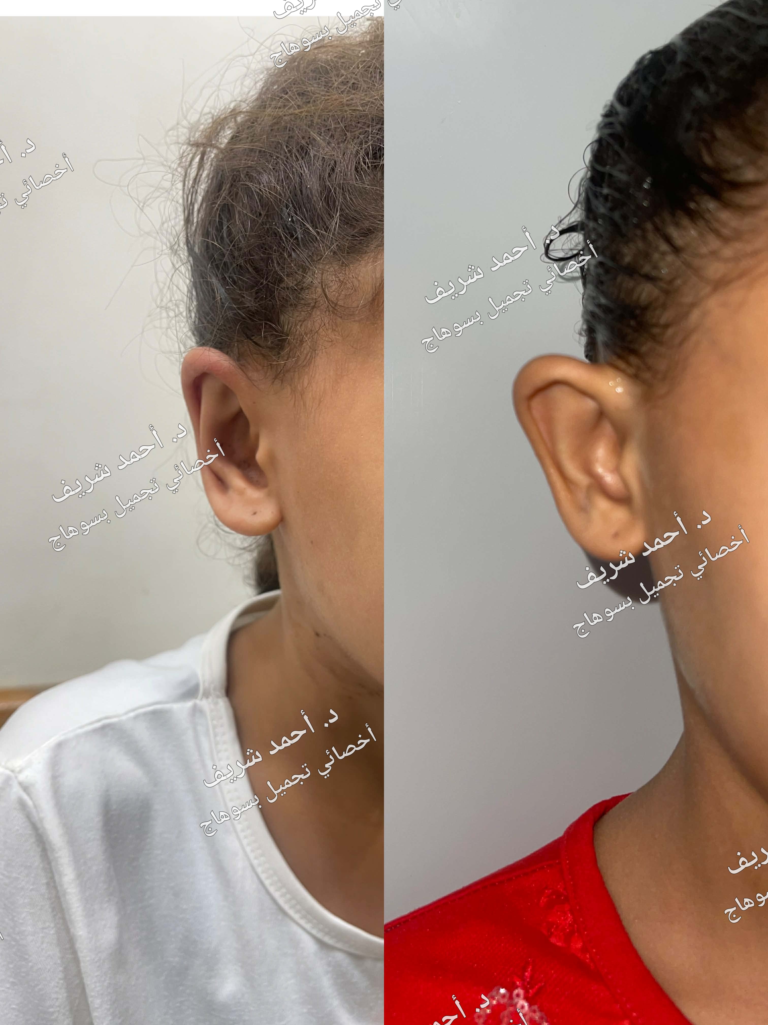 تجميل الأذن